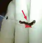 Stent Retriever Gerinnsel