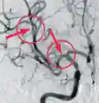 Stent Retriever nachher