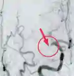 Stent Retriever vorher