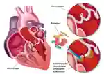 2021 Endocarditis A St204421255 Text DE