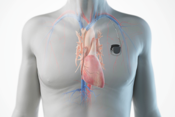 Wie funktioniert ein Herzschrittmacher? - Schweizerische Herzstiftung